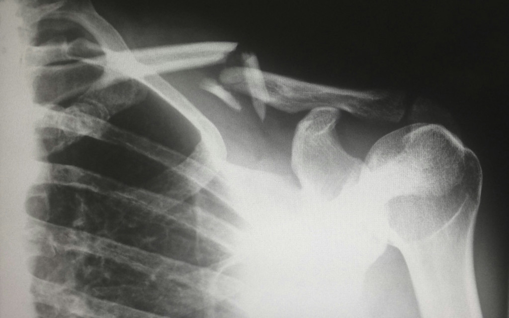 x-ray image of a person with a broken collar bone