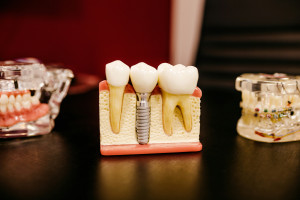 dental models on desk. Section of jaw showing implants and tooth structures below the gums